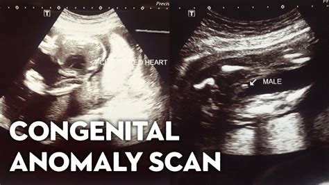 Women's Health Care Unit: Ultrasound Of Congenital Anomaly .